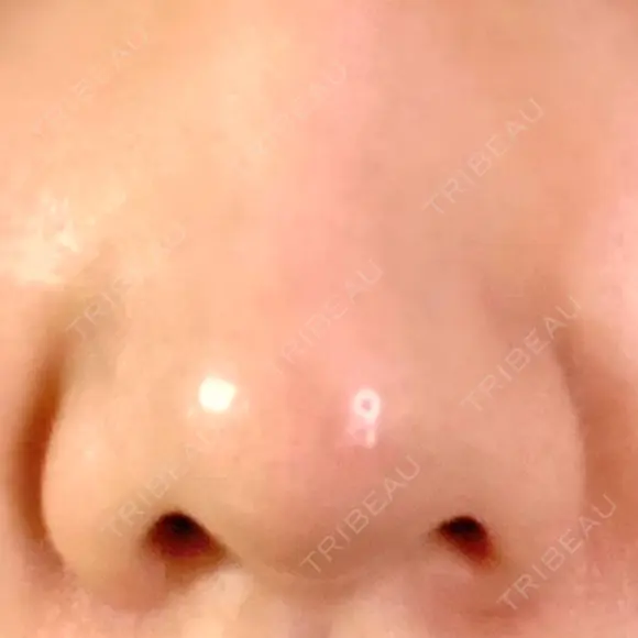 小鼻縮小（切開） GLANZ CLINIC BEFORE メイン用