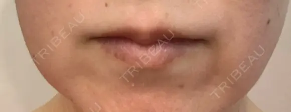 ボトックス（人中） ユウコ形成外科クリニック BEFORE メイン用