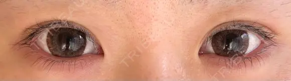 二重切開 LIKI CLINIC KOBE BEFORE メイン用