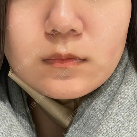 ポテンツァ レナータクリニック 立川院 BEFORE メイン用