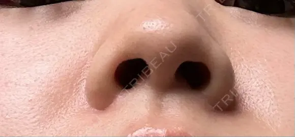 軟骨移植 / 鼻孔縁挙上 / 鼻尖縮小 くさのたろうクリニック BEFORE メイン用