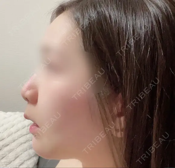 軟骨移植 ソウルクイーン整形外科（旧コエンミ整形外科） BEFORE メイン用