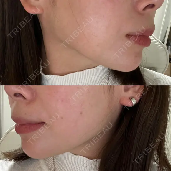 ボトックス（エラ・小顔） LE CLINIC BEFORE メイン用