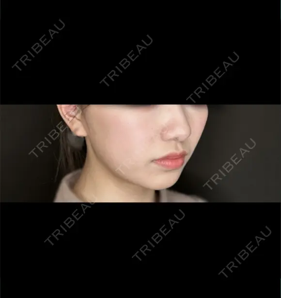 ボトックス（エラ・小顔） / ボトックス（首） 藤・ナチュレ美容クリニック 恵比寿院 BEFORE メイン用