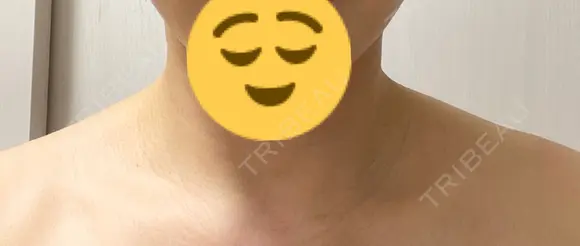 ボトックス（ふくらはぎ） / ボトックス（肩） LOUIS CLINIC 二子玉川院【ルイクリニック】 BEFORE メイン用