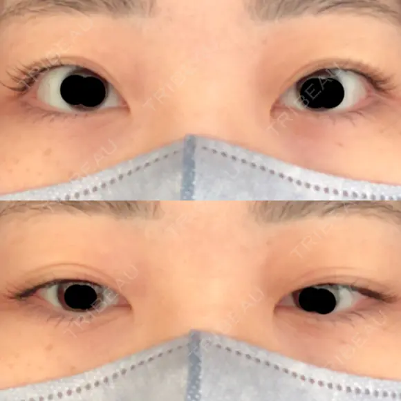 二重埋没 オーキッド美容クリニック東京御徒町 BEFORE メイン用