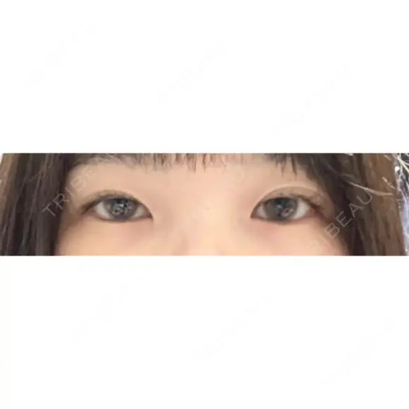 二重埋没 / 目頭切開 TCB東京中央美容外科 神戸院 BEFORE メイン用