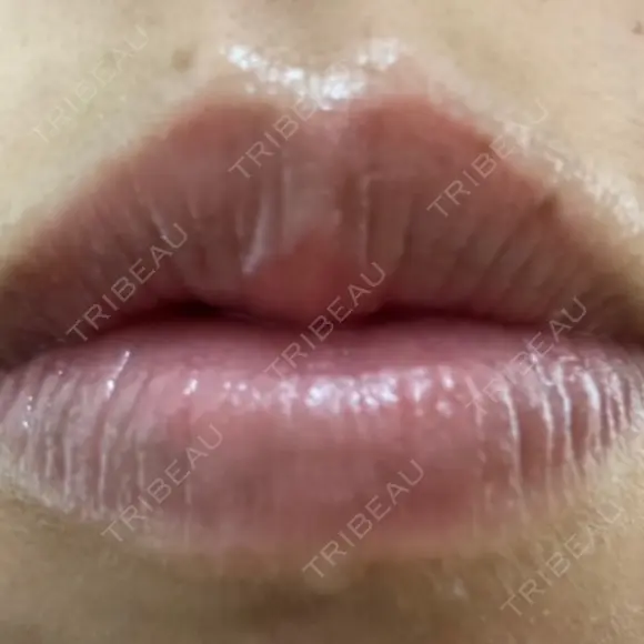 アートメイク（唇） こいずみ形成クリニック名古屋 BEFORE メイン用