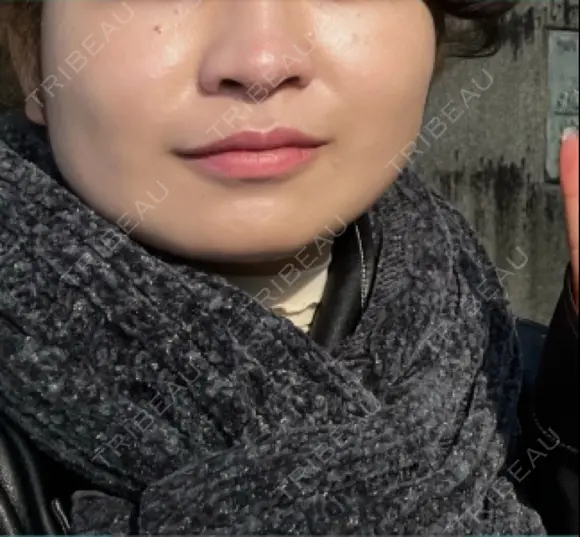 ボトックス（人中） 日比谷セントラルクリニック BEFORE メイン用