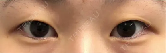 二重埋没 湘南美容クリニック 横須賀中央院 BEFORE メイン用