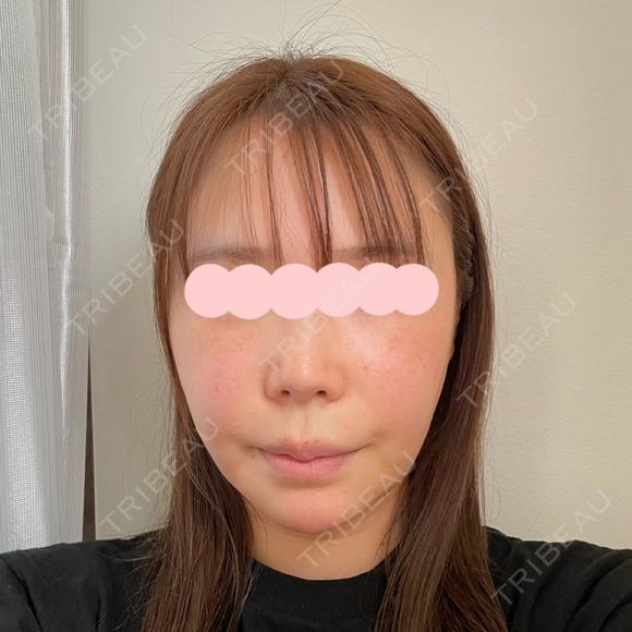 脂肪吸引（顔） / 切開リフト タシピウム整形外科 BEFORE メイン用
