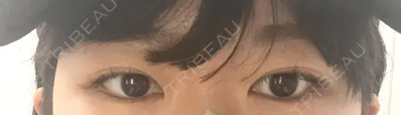 二重埋没 湘南美容クリニック 仙台院 BEFORE メイン用