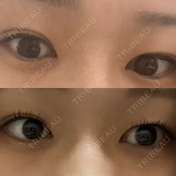 二重埋没 神戸中央クリニック美容外科 BEFORE メイン用