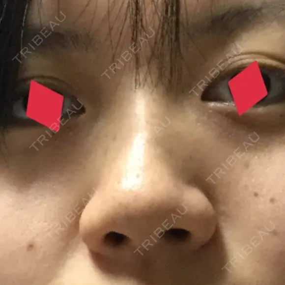 鼻尖形成（切開） / 鼻中隔延長（切開） / 小鼻縮小（切開） / 軟骨移植 / ワシ鼻修正・ハンプ切除 湘南メディカル記念病院（両国） BEFORE メイン用