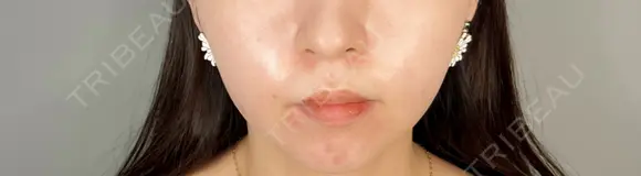 ボトックス（あご） / ヒアルロン酸注入（あご） ASTRA BEAUTY CLINIC BEFORE メイン用