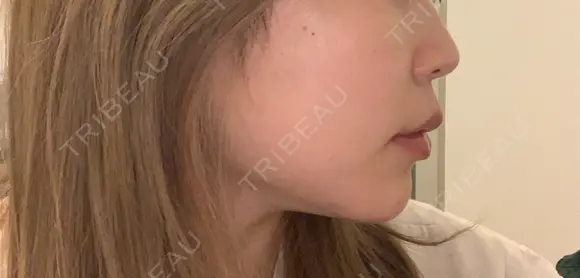 その他（輪郭） / ヒアルロン酸注入（あご） ASTRA BEAUTY CLINIC BEFORE メイン用