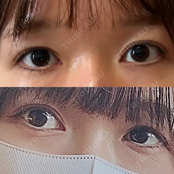 二重埋没 水の森美容クリニック 東京新宿院 BEFORE メイン用