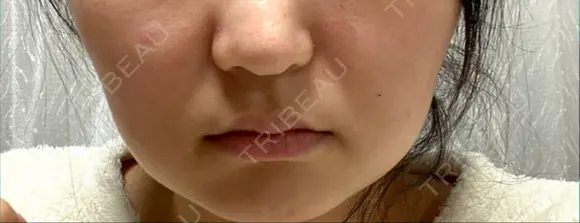 光治療（フォトフェイシャルなど） アムルーズ美容外科クリニック 大阪院 BEFORE メイン用
