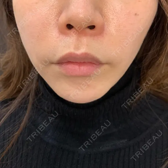 ヒアルロン酸注入（唇） / ボトックス（口角） ルラ美容クリニック 高田馬場院 BEFORE メイン用