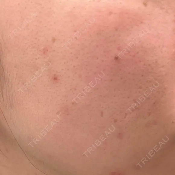 ピコフラクショナルレーザー（毛穴・ニキビ跡） CLINICA BellaForma BEFORE メイン用