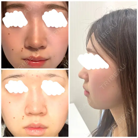 鼻尖形成（切開） / 小鼻縮小（切開） / 軟骨移植 / 鼻尖縮小 高崎美容クリニック BEFORE メイン用
