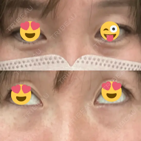 クマ治療 / 下まぶたの脂肪取り / ヒアルロン酸注入（目の下） / ボトックス（眉間） / ボトックス（目尻） / その他（鼻） YBC横浜美容外科 大宮院 BEFORE メイン用