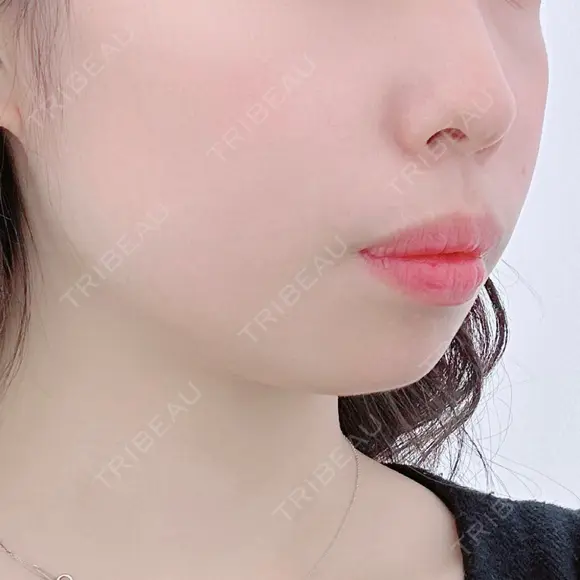 ヒアルロン酸注入（あご） ASTRA BEAUTY CLINIC BEFORE メイン用