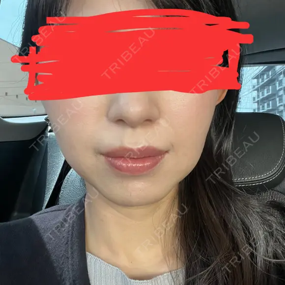 ボトックス（エラ・小顔） あいちビューティークリニック BEFORE メイン用