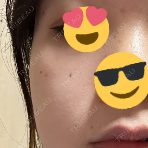 ほくろ・いぼ除去レーザー（肌） 心斎橋形成外科スキンケアクリニック BEFORE メイン用