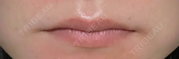 ヒアルロン酸注入（唇） / ボトックス（口角） ブルームクリニック（BLOOM CLINIC） BEFORE メイン用