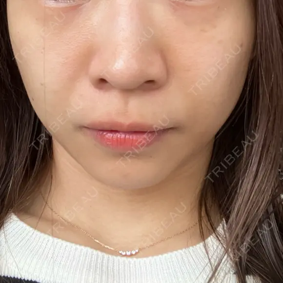 ヒアルロン酸注入（頬） 心斎橋形成外科スキンケアクリニック BEFORE メイン用