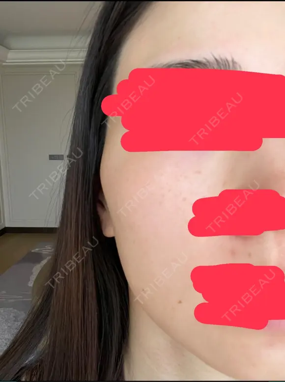 シミ取りレーザー CLINICA BellaForma BEFORE メイン用