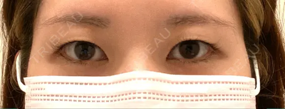 二重埋没 Olino美容外科・美容皮膚科 BEFORE メイン用
