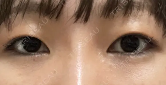 二重埋没 東京エビスクリニック BEFORE メイン用