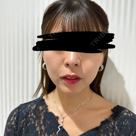 肌ヒアルロン酸注入（たるみ・シワ改善） / ヒアルロン酸注入（あご） / ボトックス（エラ・小顔） LE CLINIC BEFORE メイン用