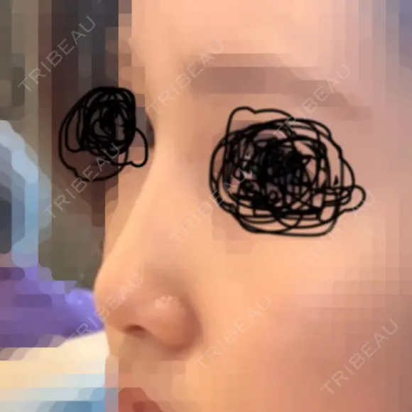 隆鼻術 / 鼻尖縮小 エースクリニック 名古屋院 BEFORE メイン用