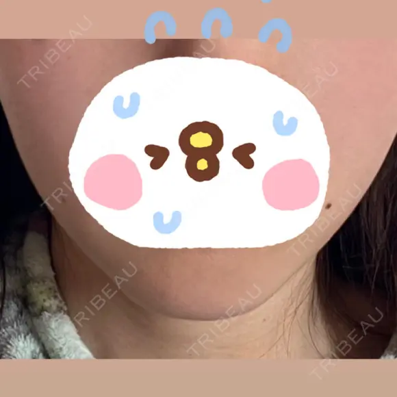 脂肪溶解注射（顔） LIGHT CLINIC 【ライトクリニック】 名古屋院 BEFORE メイン用