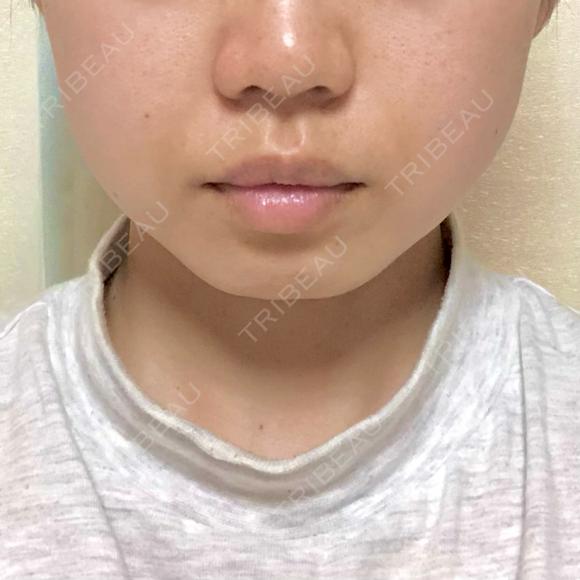 ボトックス（エラ・小顔） 仙台TAクリニック BEFORE メイン用