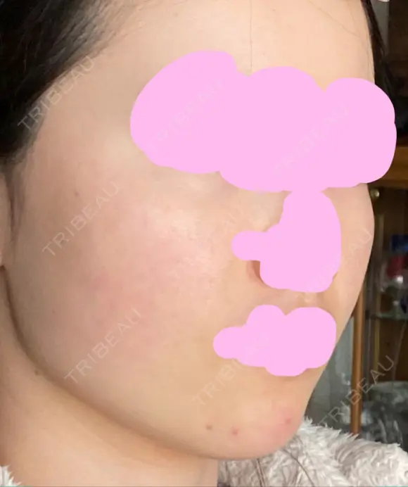 ボトックス（エラ・小顔） TCB東京中央美容外科 上野院 BEFORE メイン用