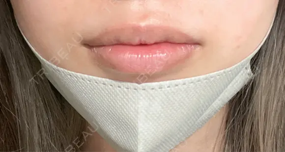 口唇縮小術 B-LINE CLINIC 池袋院 BEFORE メイン用