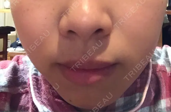 ガミースマイル手術 / 脂肪溶解注射（顔） 湘南美容クリニック 浜松院 BEFORE メイン用