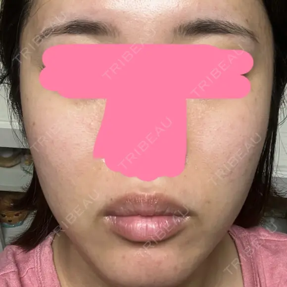 ヒアルロン酸注入（唇） / ボトックス（口角） / ヒアルロン酸注入（頬） KAGA CLINIC BEFORE メイン用