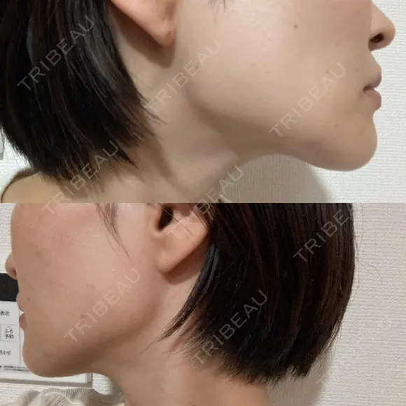 ボトックス（エラ・小顔） TCB東京中央美容外科 福岡博多院 BEFORE メイン用