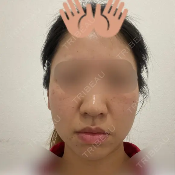 脂肪溶解注射（顔） TCB東京中央美容外科 横浜院 BEFORE メイン用