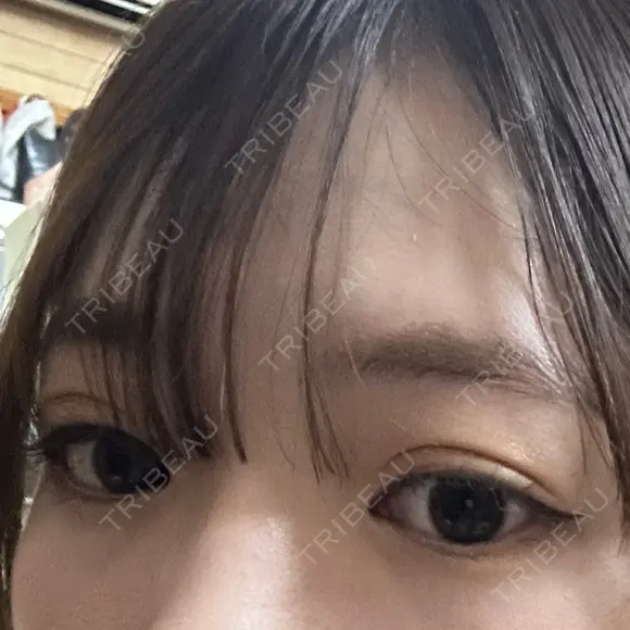 ヒアルロン酸注入（涙袋） Olino美容外科・美容皮膚科 BEFORE メイン用