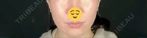 糸リフト / 脂肪吸引（顔） / ボトックス（エラ・小顔） TOTAL BEAUTY CLINIC BEFORE メイン用