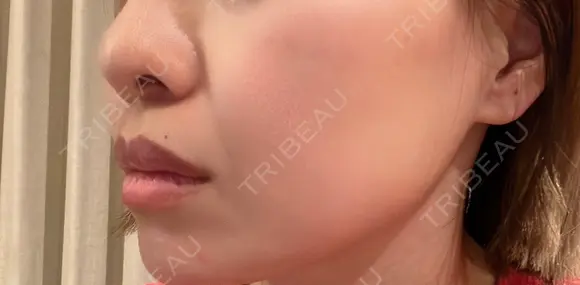 ボトックス（エラ・小顔） TCB東京中央美容外科 静岡院 BEFORE メイン用