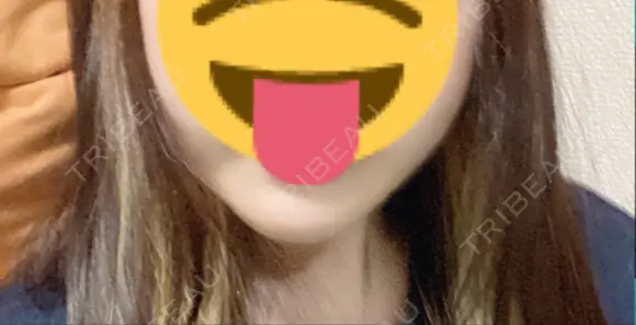 脂肪溶解注射（顔） TCB東京中央美容外科 新潟院 BEFORE メイン用