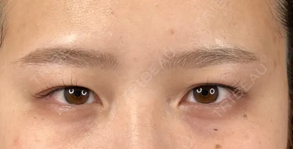 二重切開 / 目頭切開 藤・ナチュレ美容クリニック 恵比寿院 BEFORE メイン用