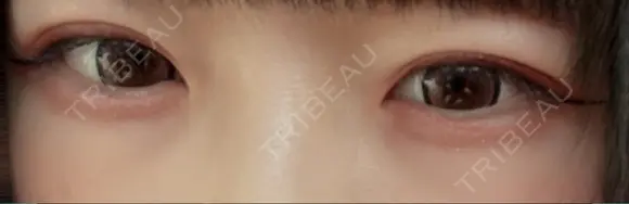 下まぶたの脂肪取り / ヒアルロン酸注入（涙袋） / ヒアルロン酸注入（目の下） / ベビーコラーゲン TCB スキンクリニック 大阪駅前院 BEFORE メイン用